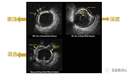 图文并茂：钙化病变利器