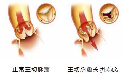 憋气、心绞痛，心脏出问题不止要考虑血管狭窄