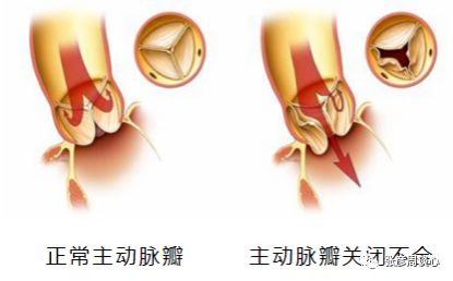 憋气、心绞痛，心脏出问题不止要考虑血管狭窄