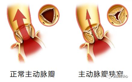 憋气、心绞痛，心脏出问题不止要考虑血管狭窄