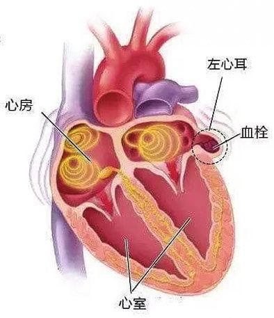 给你的心“添堵”-左心耳封堵术