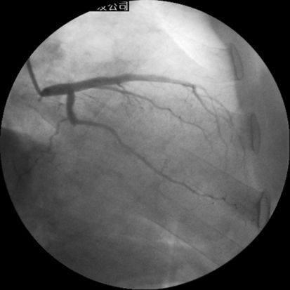 介入医师必看—冠脉造影的判断与评估