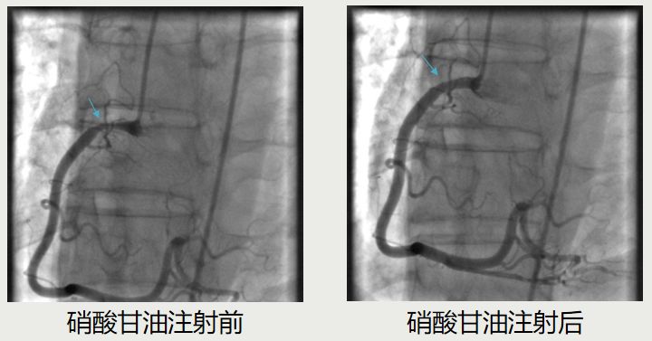 介入医师必看—冠脉造影的判断与评估