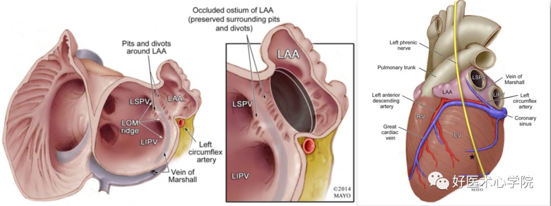 关于“鸡翅型”左心耳封堵策略，掌握这些要点，少走弯路！