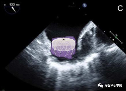 关于“鸡翅型”左心耳封堵策略，掌握这些要点，少走弯路！