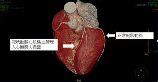 5分钟读懂心肌桥