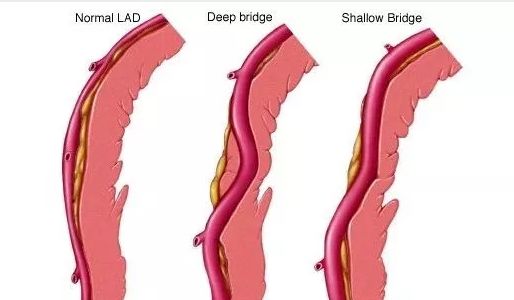 5分钟读懂心肌桥