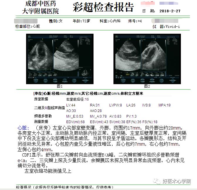 细数急性心梗合并顽固性心衰的N种处理对策