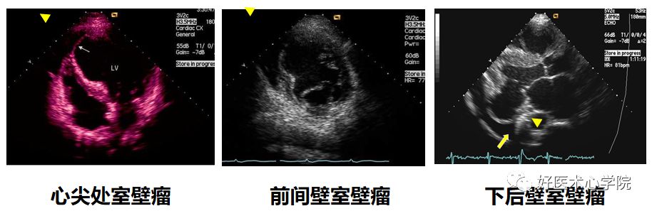 细数急性心梗合并顽固性心衰的N种处理对策