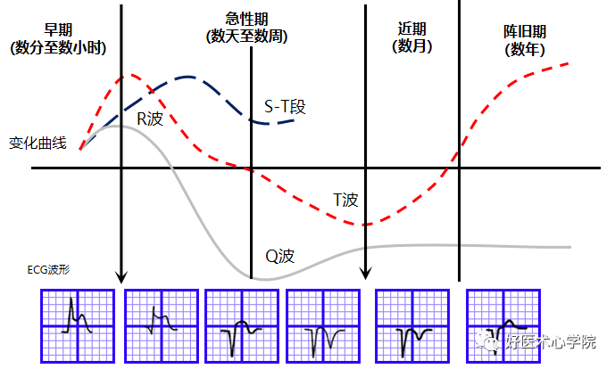 细数急性心梗合并顽固性心衰的N种处理对策