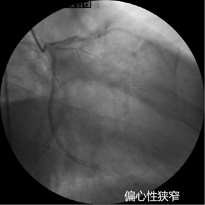 介入医师必看—冠脉造影的判断与评估