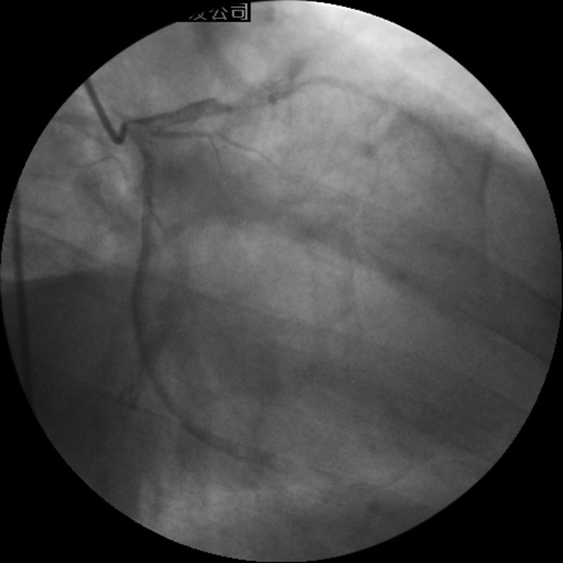 介入医师必看—冠脉造影的判断与评估