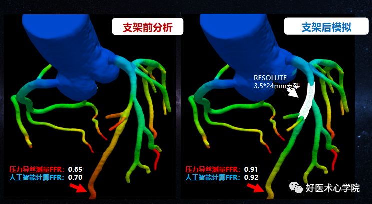 冠心病介入治疗的新技术,来挑战吧！