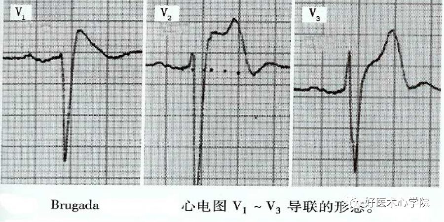 ST段抬高的胸痛，冠脉造影却正常，应该考虑什么疾病？