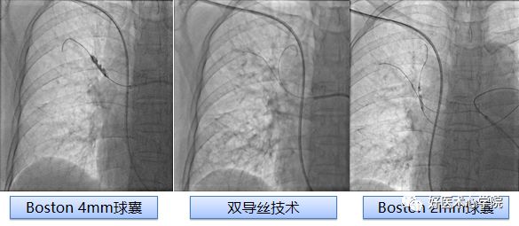 一看狭窄就想到血栓？那肺血管狭窄是什么原因