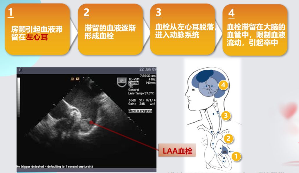 干货！左心耳封堵术实操技巧