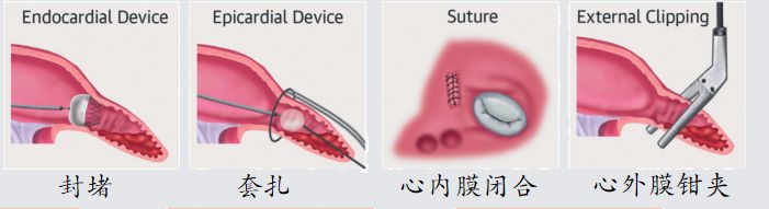 干货！左心耳封堵术实操技巧