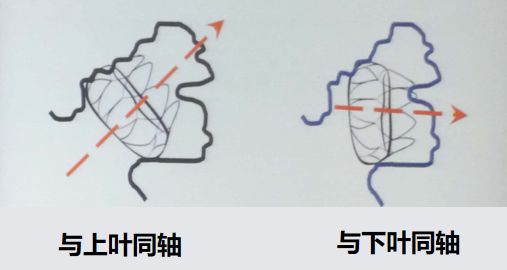 干货！左心耳封堵术实操技巧