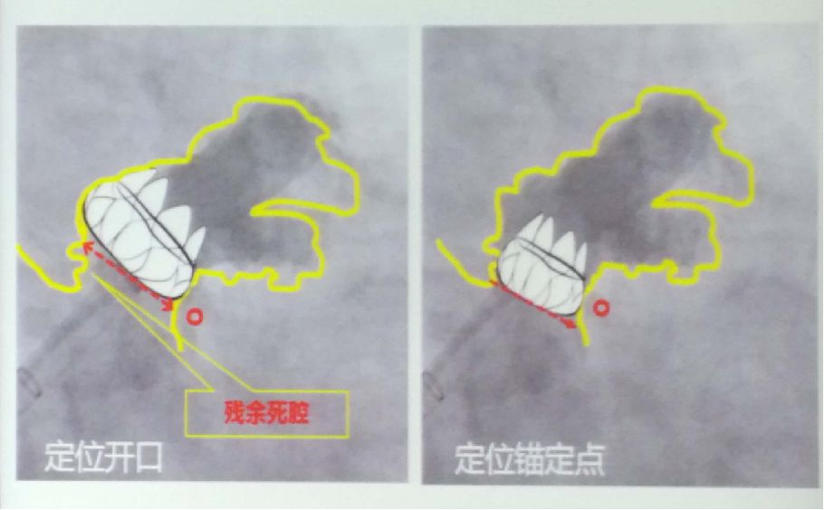 干货！左心耳封堵术实操技巧