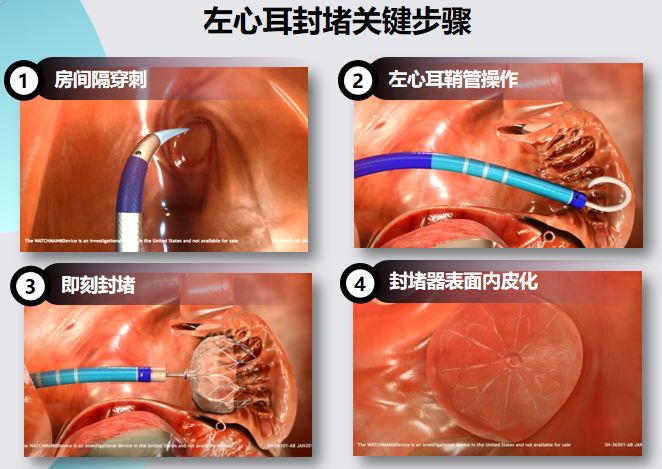 干货！左心耳封堵术实操技巧