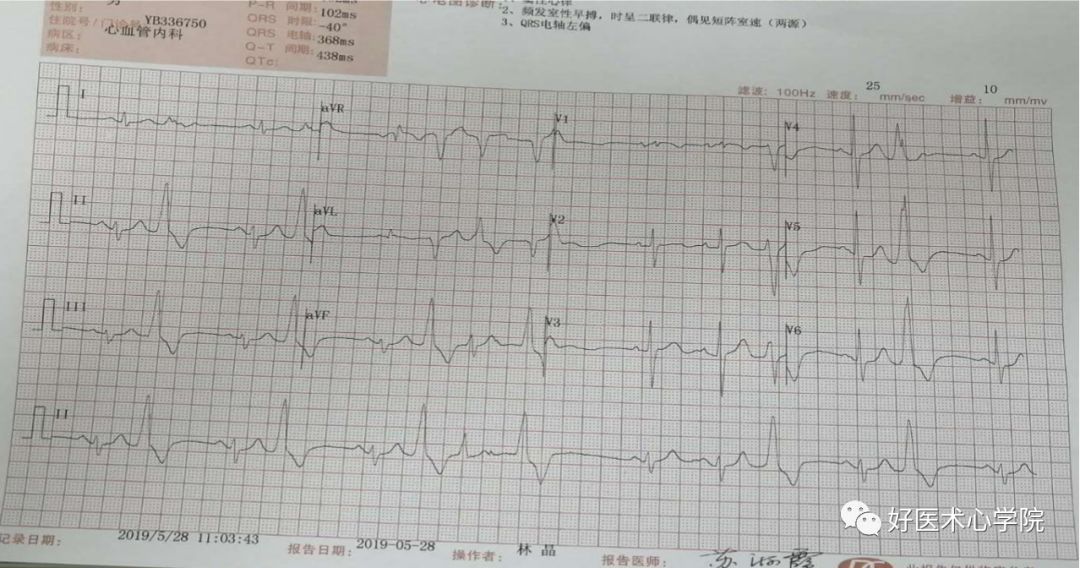 四个病例带你深度剖析室早的导管消融治疗