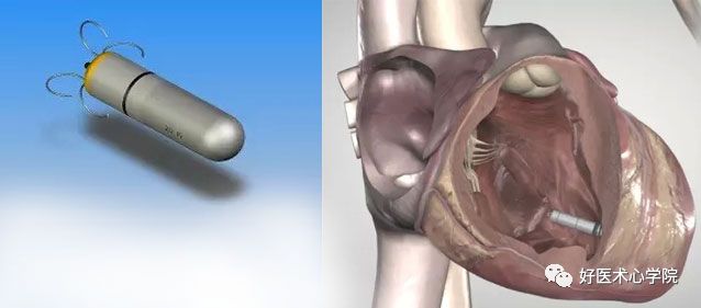 因“心”而生：四种心脏植入式电子装置