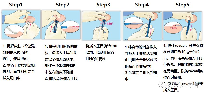 因“心”而生：四种心脏植入式电子装置