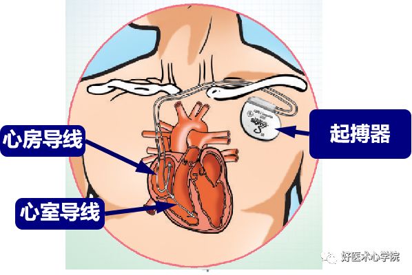 因“心”而生：四种心脏植入式电子装置