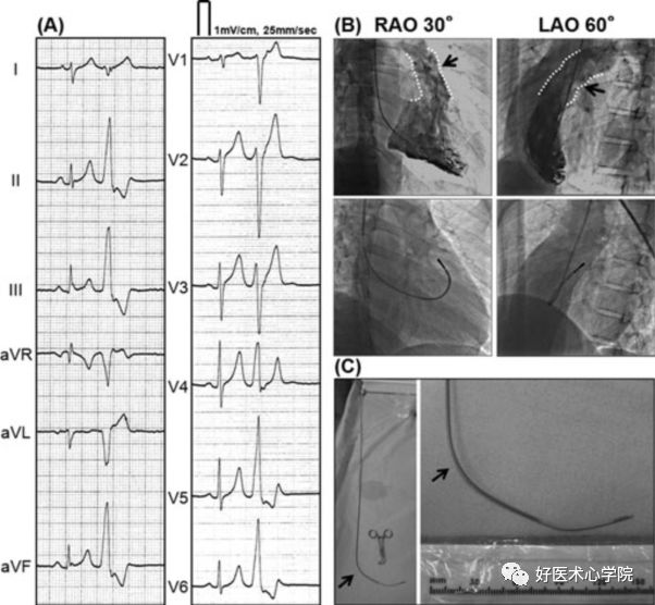 四个病例带你深度剖析室早的导管消融治疗
