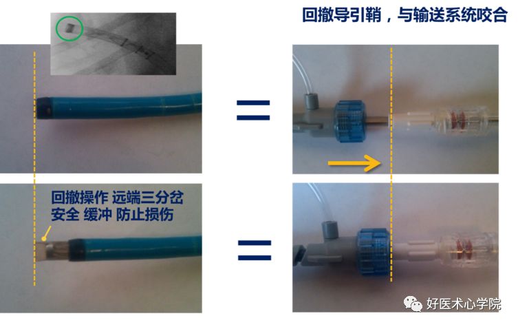 左心耳封堵术流程攻略