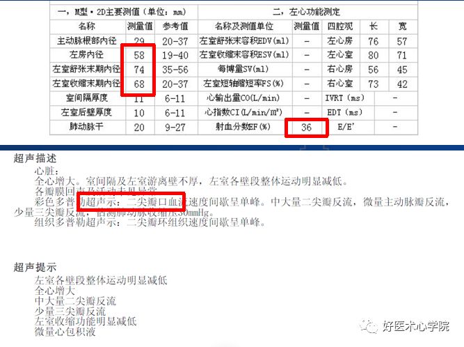 实用攻略贴！左室电极靶静脉植入操作技巧！