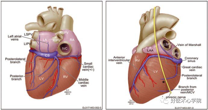 实用攻略贴！左室电极靶静脉植入操作技巧！