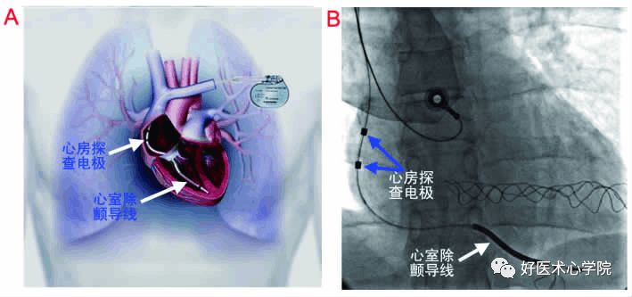 步步为营！讲解恶性心律失常杀手——ICD植入技术