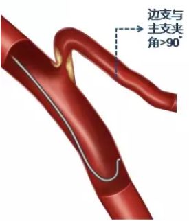 型随意动—分叉病变导丝的选择塑形与操作技巧