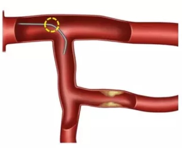 型随意动—分叉病变导丝的选择塑形与操作技巧