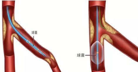 型随意动—分叉病变导丝的选择塑形与操作技巧