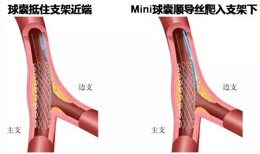 型随意动—分叉病变导丝的选择塑形与操作技巧