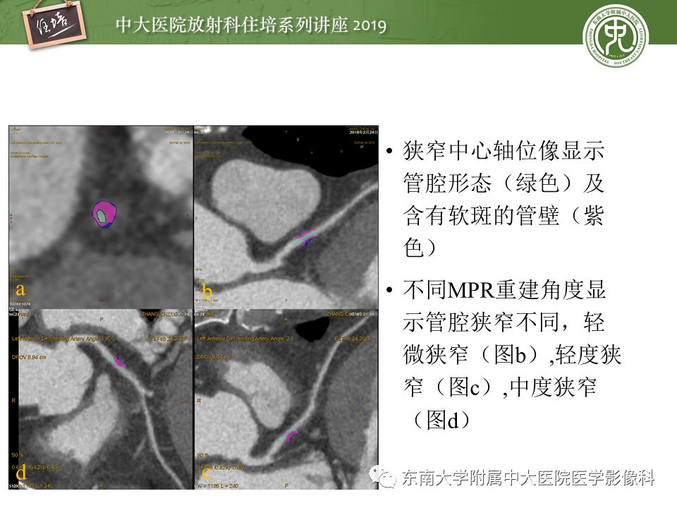 不能错过！冠状动脉CTA诊断超全教程