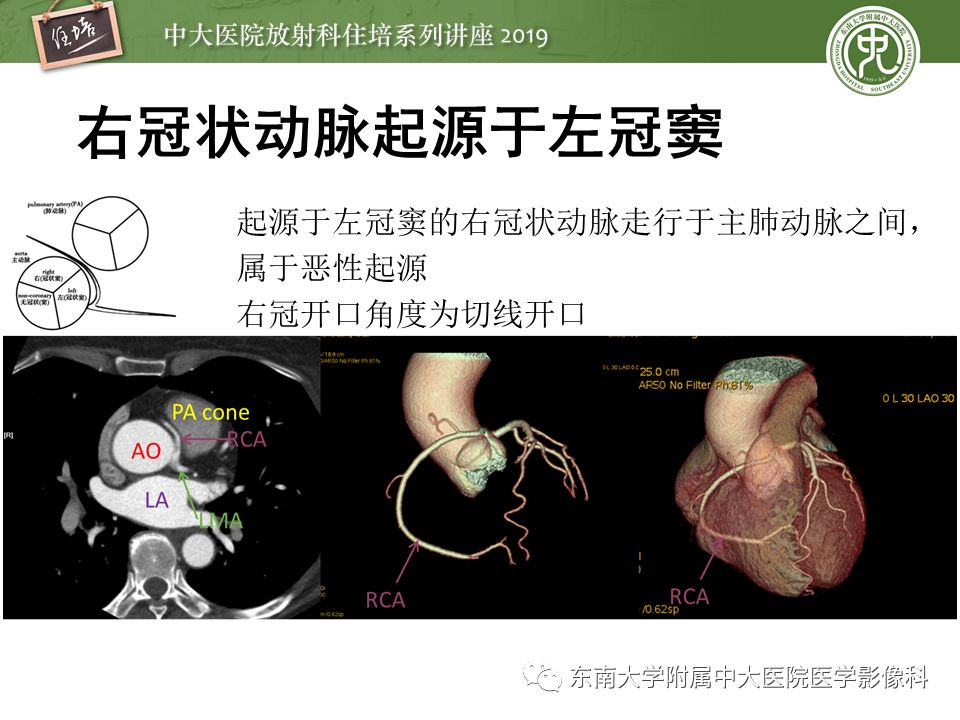 不能错过！冠状动脉CTA诊断超全教程