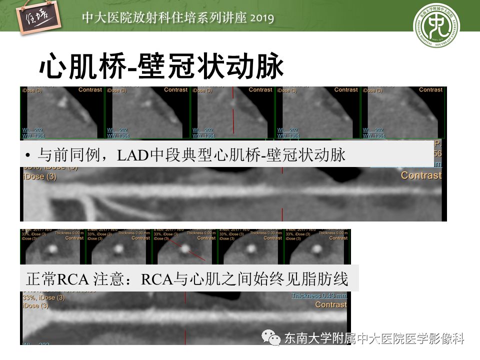 不能错过！冠状动脉CTA诊断超全教程