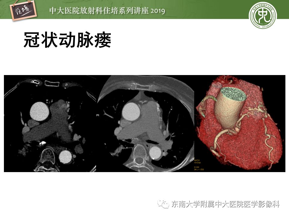 不能错过！冠状动脉CTA诊断超全教程