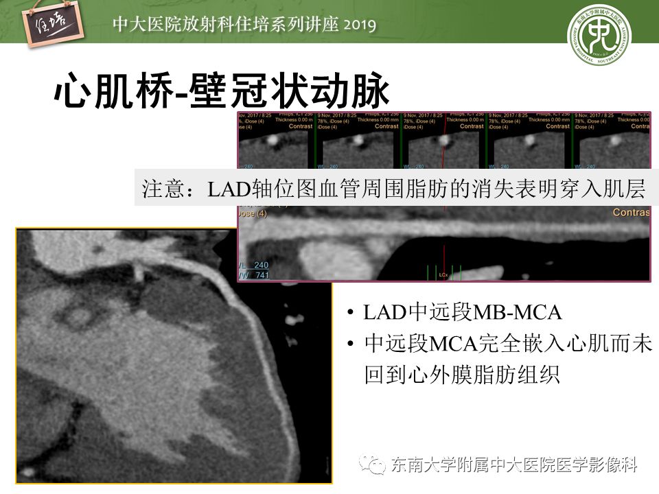 不能错过！冠状动脉CTA诊断超全教程