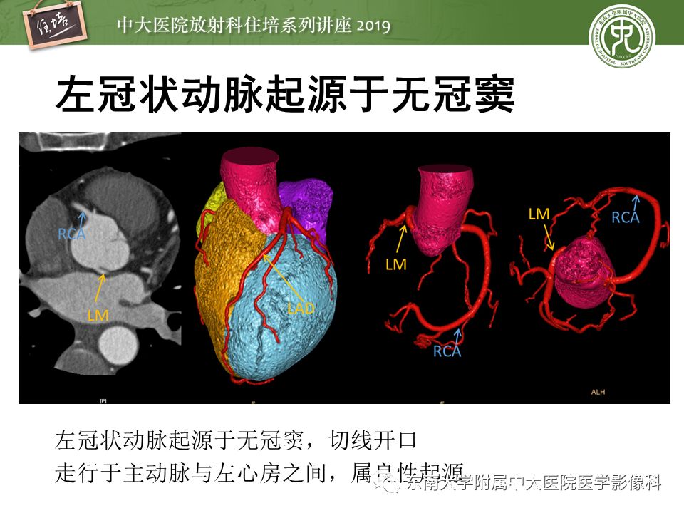 不能错过！冠状动脉CTA诊断超全教程