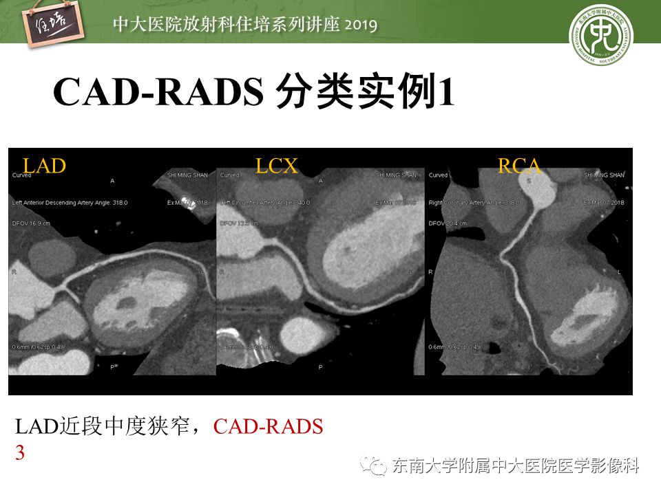 不能错过！冠状动脉CTA诊断超全教程