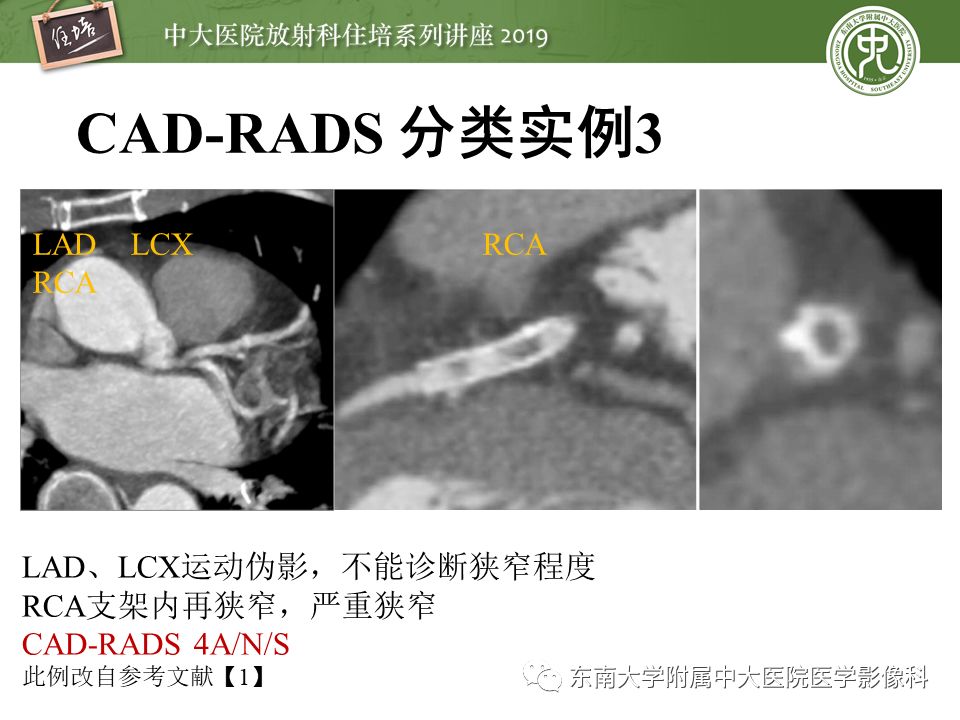 不能错过！冠状动脉CTA诊断超全教程