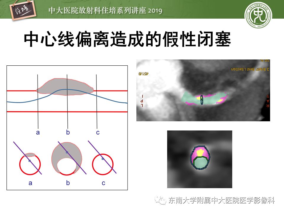 不能错过！冠状动脉CTA诊断超全教程