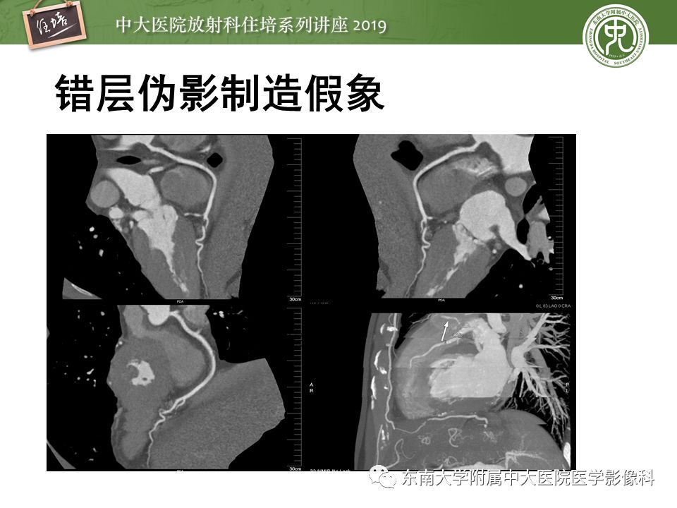 不能错过！冠状动脉CTA诊断超全教程