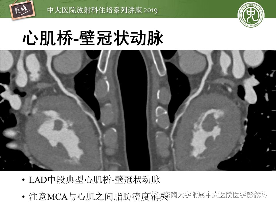 不能错过！冠状动脉CTA诊断超全教程