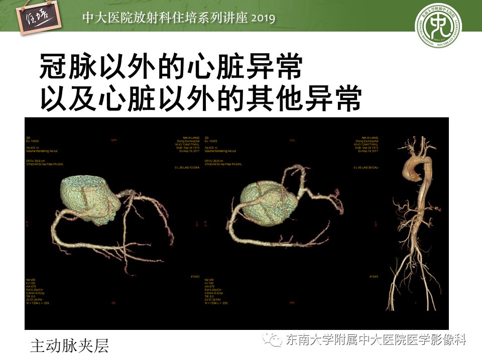 不能错过！冠状动脉CTA诊断超全教程