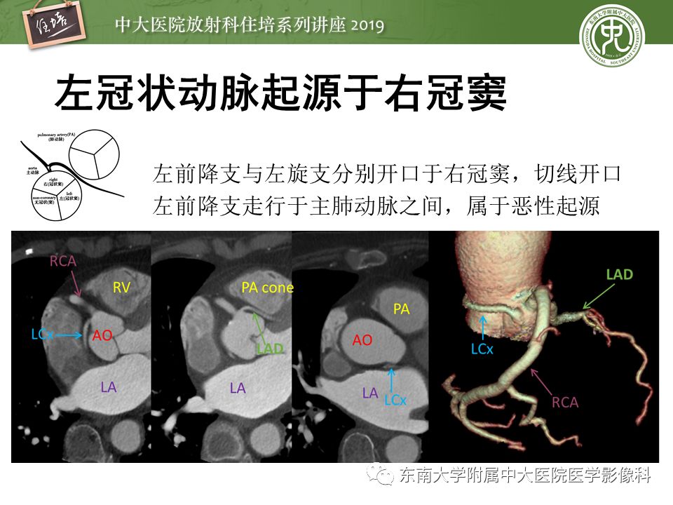 不能错过！冠状动脉CTA诊断超全教程